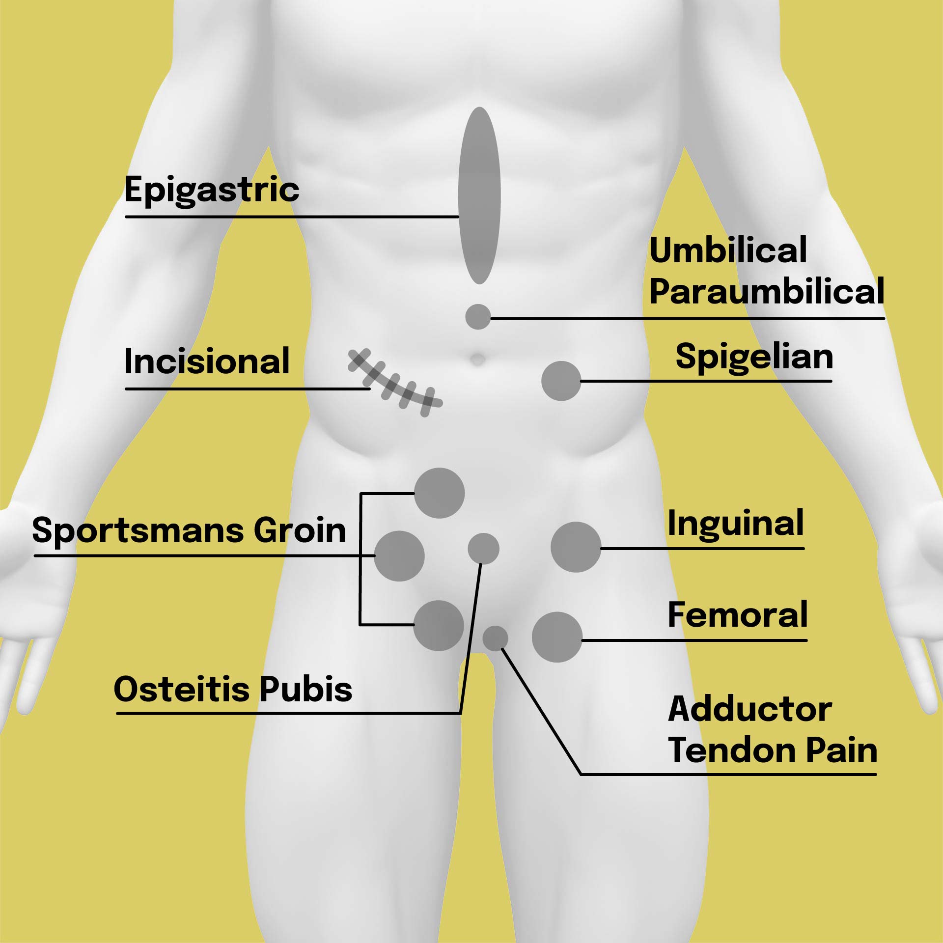 Hernia Types The Hernia Clinic   Thc Diagram 